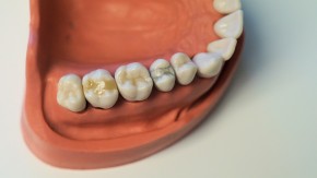 F&uuml;llungstherapie